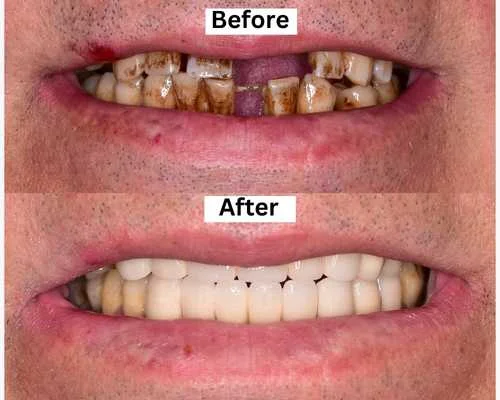 Full Mouth Rehabilitation in Tirupur