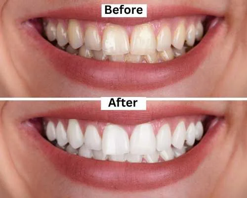 Fluoride Application