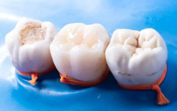Pit and Fissure Sealants in Tirupur
